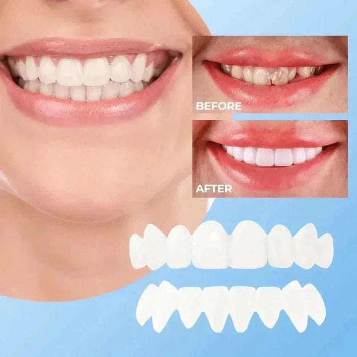 Instant Smile Perfection: Natural-Look Clip-On Cosmetic Veneers