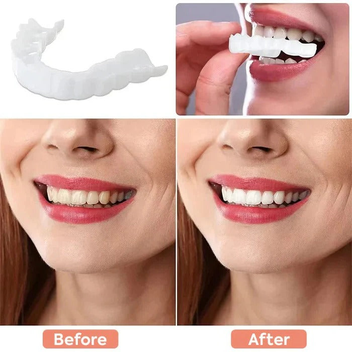 Instant Smile Perfection: Natural-Look Clip-On Cosmetic Veneers